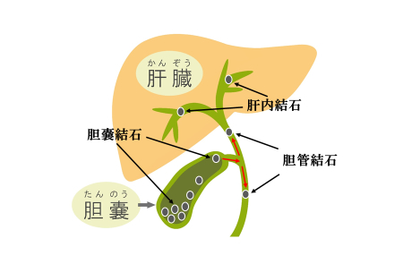 胆嚢 ポリープ 原因