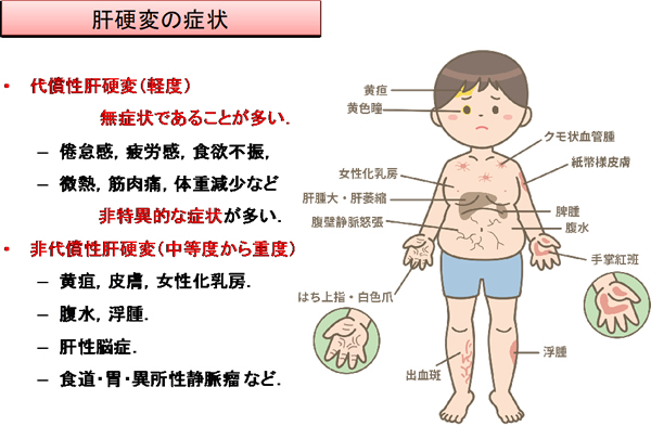 代償性肝硬変と非代償性肝硬変の原因は何ですか?