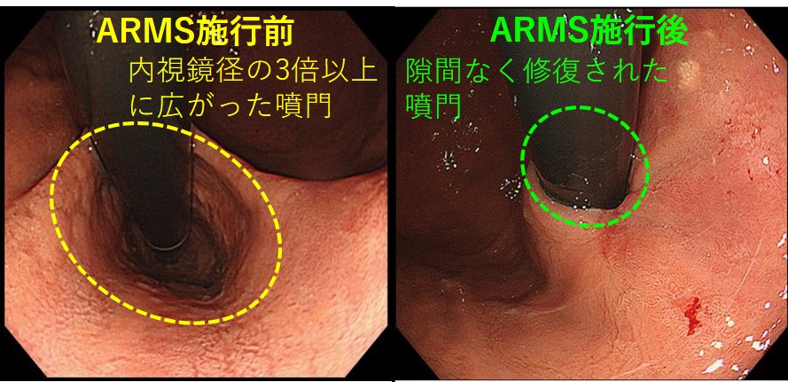 ARMS_内視鏡画像