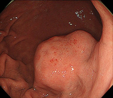胃粘膜下腫瘍-内視鏡画像